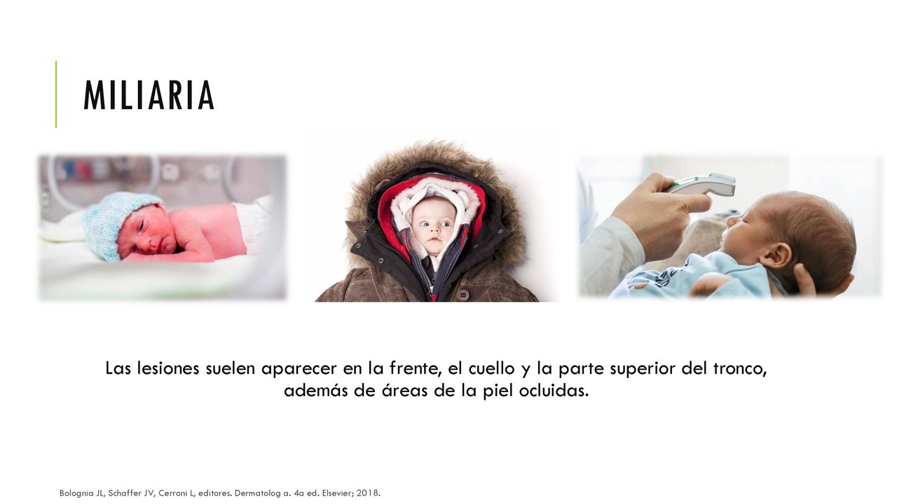 Miliaria Las lesiones suelen aparecer en la frente, el cuello y la parte superior del tronco, además de áreas de la piel ocluidas.