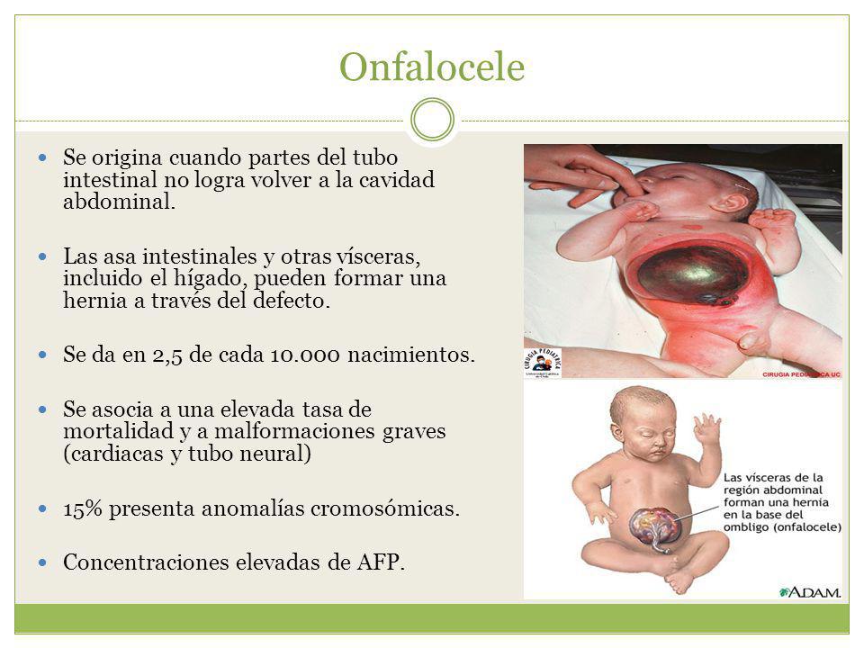 Onfalocele Se origina cuando partes del tubo intestinal no logra volver a la cavidad abdominal.