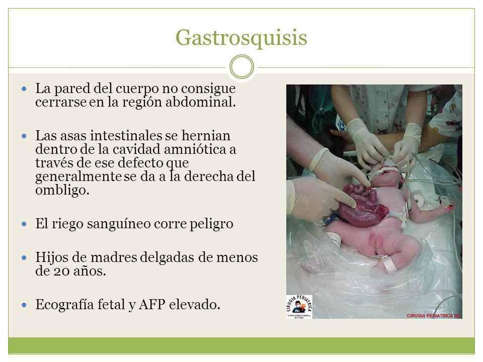 Gastrosquisis La pared del cuerpo no consigue cerrarse en la región abdominal.