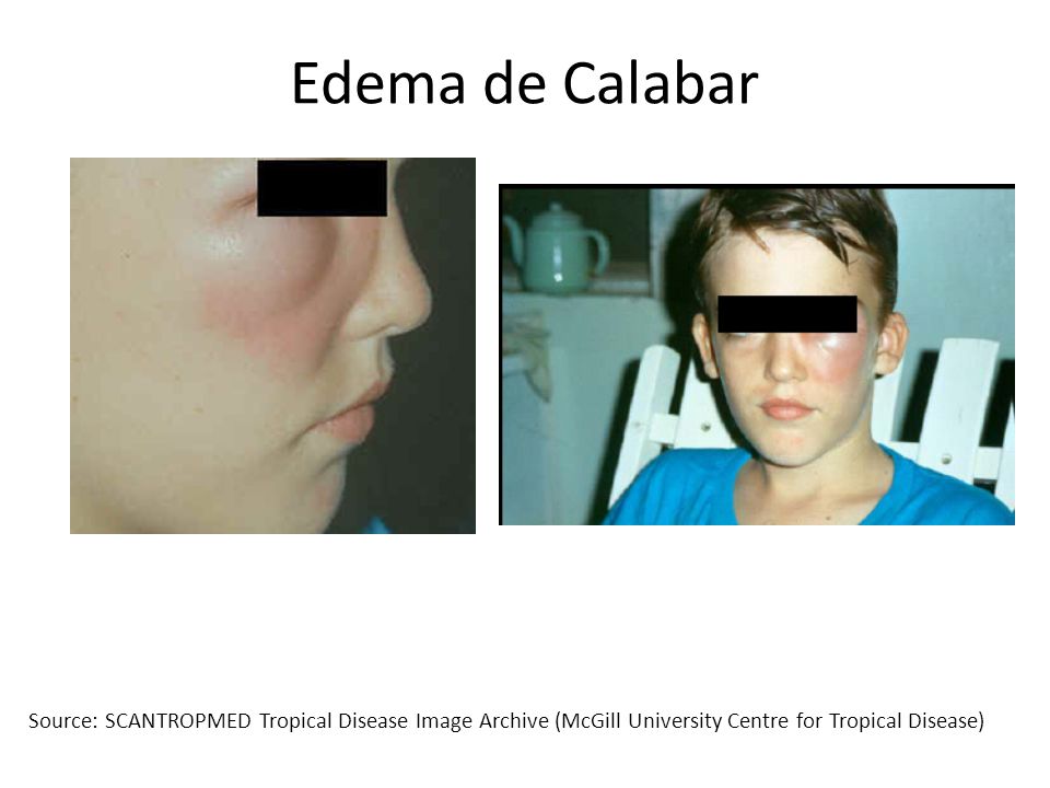 Edema de Calabar Source: SCANTROPMED Tropical Disease Image Archive (McGill University Centre for Tropical Disease)