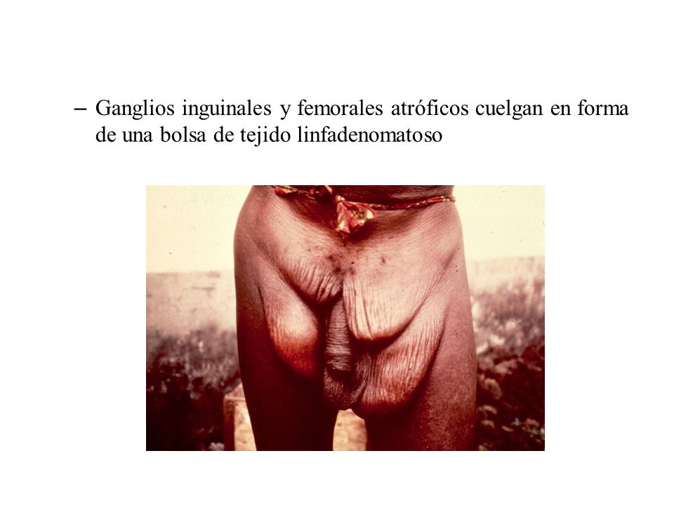 Ganglios inguinales y femorales atróficos cuelgan en forma de una bolsa de tejido linfadenomatoso
