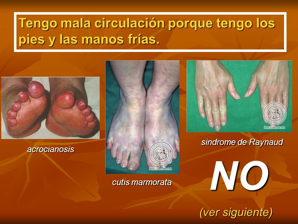NO Tengo mala circulación porque tengo los pies y las manos frías.