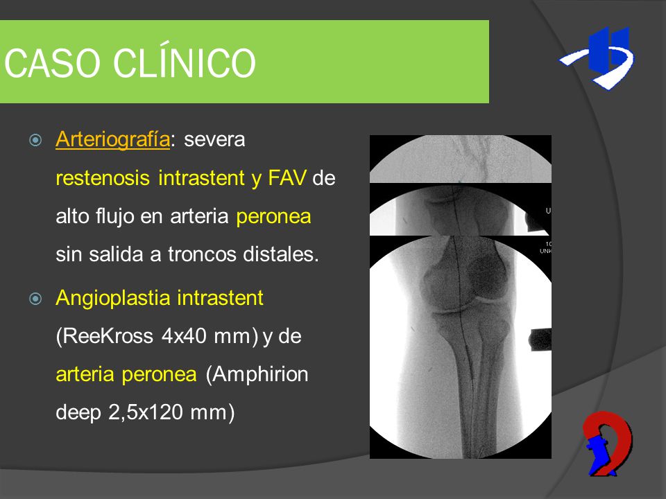 CASO CLÍNICO Arteriografía: severa restenosis intrastent y FAV de alto flujo en arteria peronea sin salida a troncos distales.