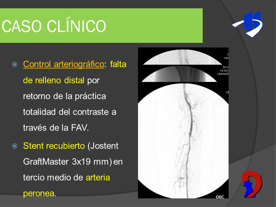 CASO CLÍNICO Control arteriográfico: falta de relleno distal por retorno de la práctica totalidad del contraste a través de la FAV.