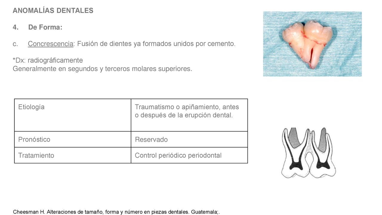 c. Concrescencia: Fusión de dientes ya formados unidos por cemento.