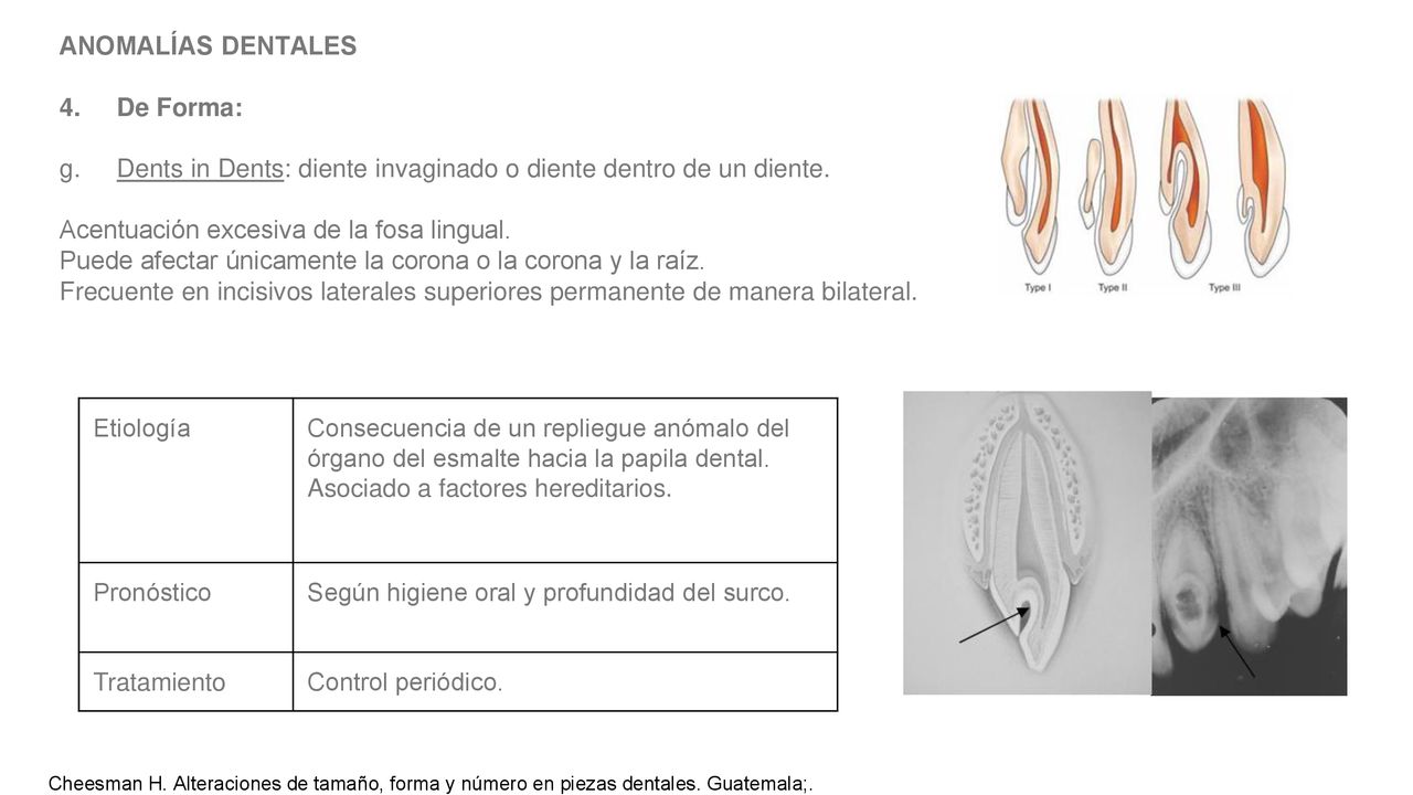 g. Dents in Dents: diente invaginado o diente dentro de un diente.