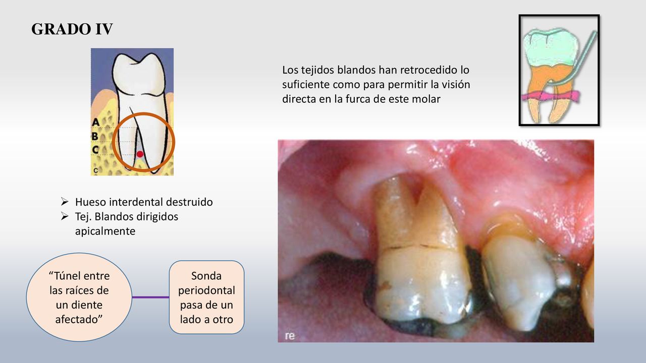 GRADO IV Los tejidos blandos han retrocedido lo suficiente como para permitir la visión directa en la furca de este molar.