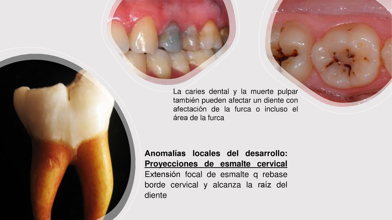 La caries dental y la muerte pulpar también pueden afectar un diente con afectación de la furca o incluso el área de la furca