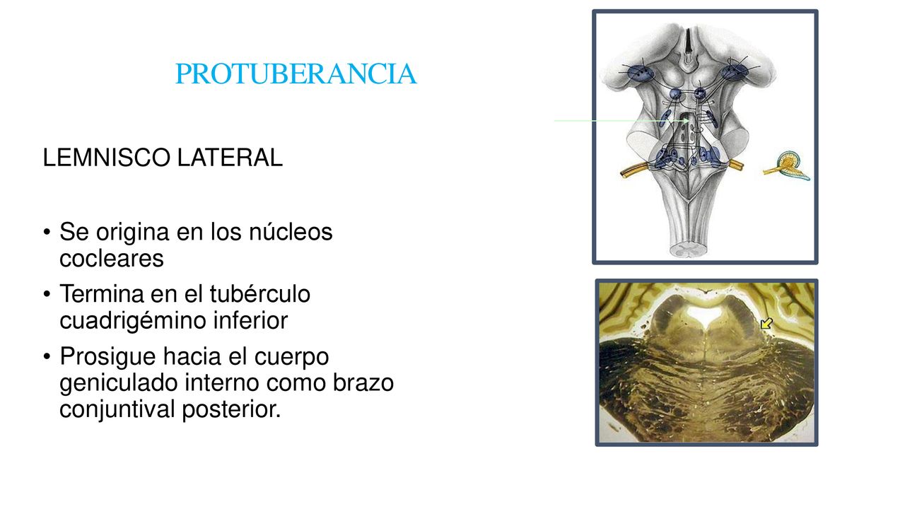 PROTUBERANCIA LEMNISCO LATERAL Se origina en los núcleos cocleares