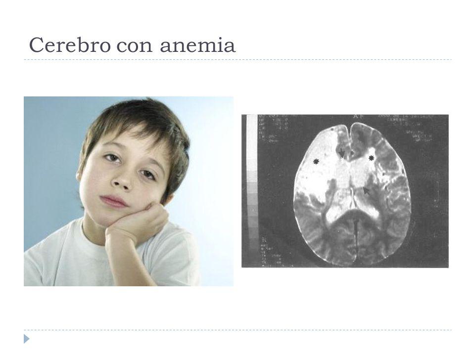 Cerebro con anemia
