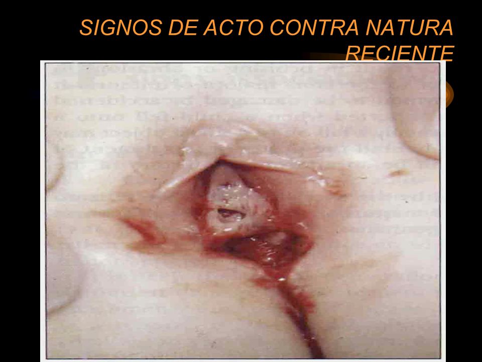 SIGNOS DE ACTO CONTRA NATURA RECIENTE