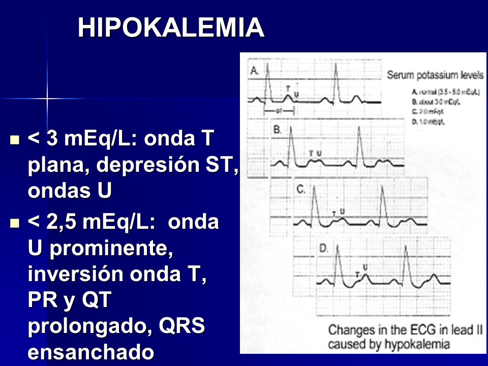 HIPOKALEMIA < 3 mEq/L: onda T plana, depresión ST, ondas U