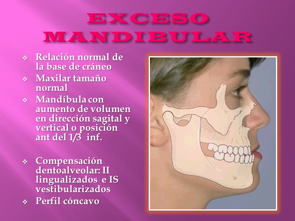 EXCESO MANDIBULAR Relación normal de la base de cráneo
