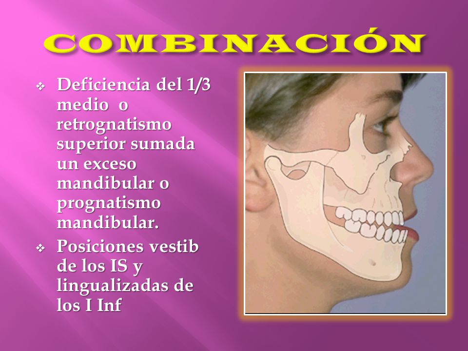 COMBINACIÓN Deficiencia del 1/3 medio o retrognatismo superior sumada un exceso mandibular o prognatismo mandibular.