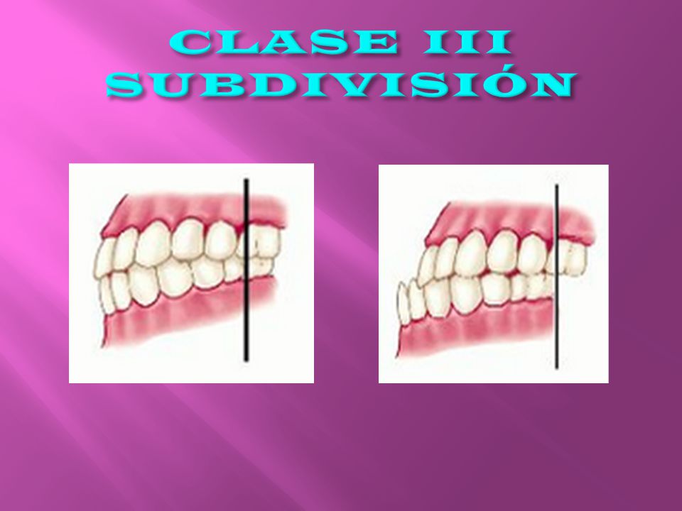CLASE III SUBDIVISIÓN Es cuando la relación sagital de los 1ros molares permanentes es de un lado clase I y del otro clase III.