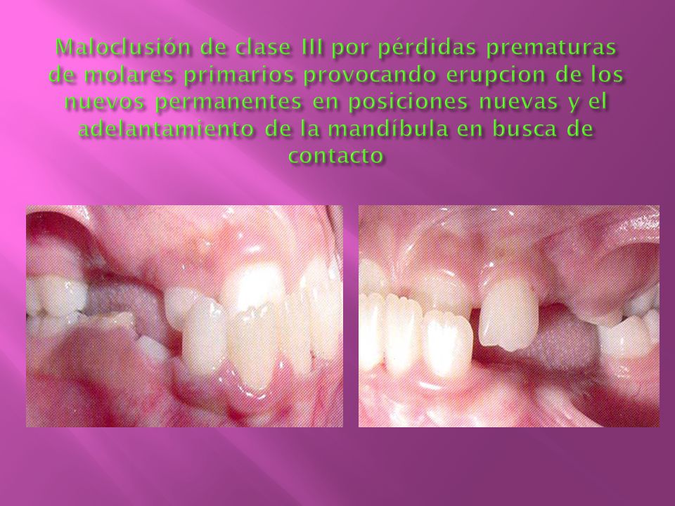 Maloclusión de clase III por pérdidas prematuras de molares primarios provocando erupcion de los nuevos permanentes en posiciones nuevas y el adelantamiento de la mandíbula en busca de contacto