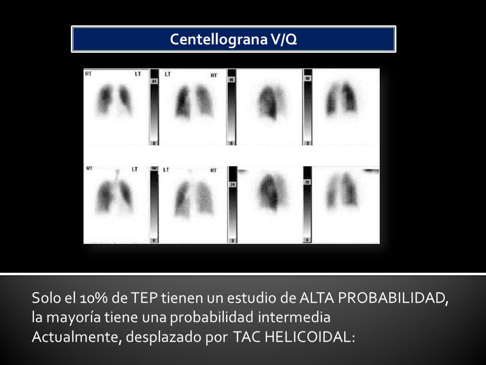 Centellograna V/Q Solo el 10% de TEP tienen un estudio de ALTA PROBABILIDAD, la mayoría tiene una probabilidad intermedia.