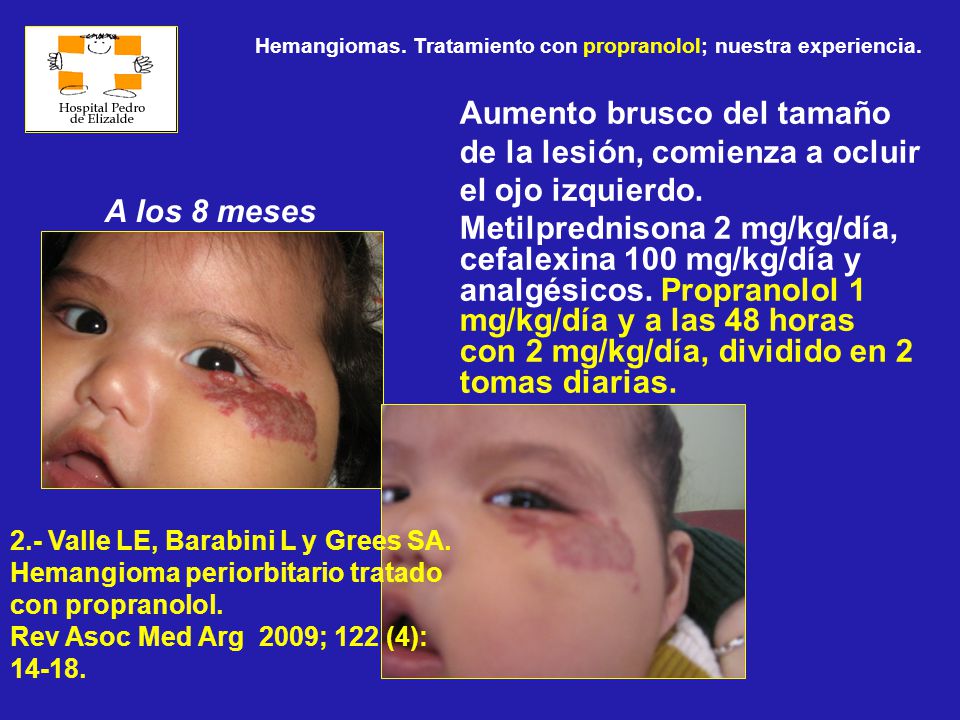 Hemangiomas. Tratamiento con propranolol; nuestra experiencia.