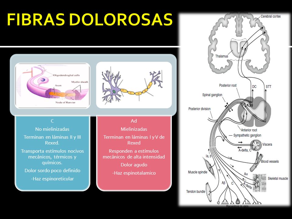 FIBRAS DOLOROSAS Transporta estímulos nocivos mecánicos, térmicos y químicos. Terminan en láminas II y III Rexed.