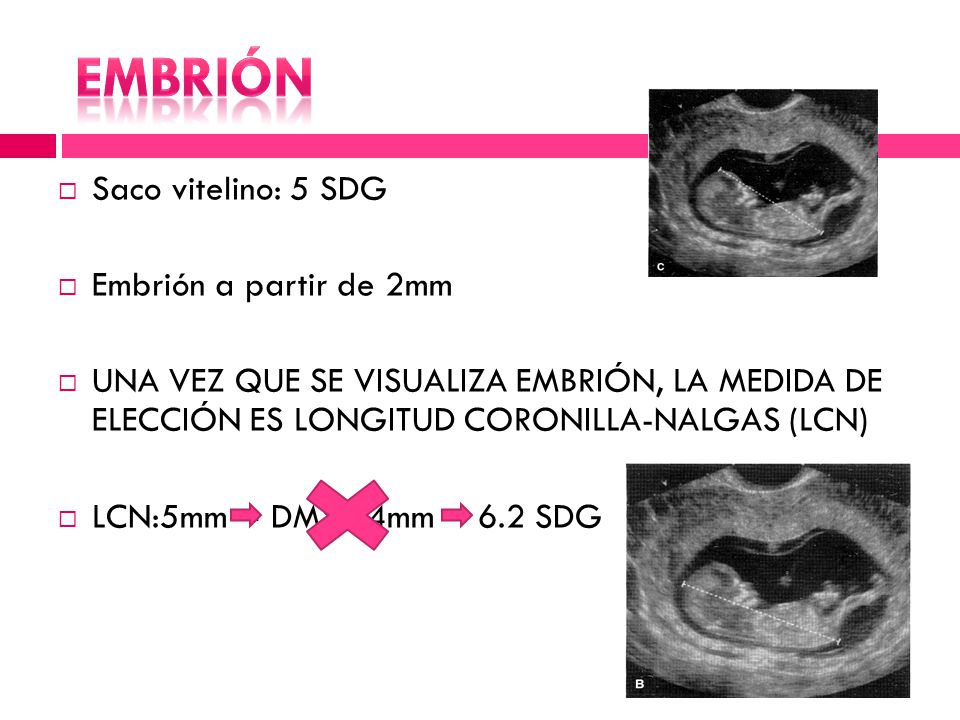 Embrión Saco vitelino: 5 SDG Embrión a partir de 2mm