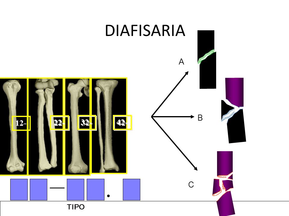 DIAFISARIA A B C — . TIPO