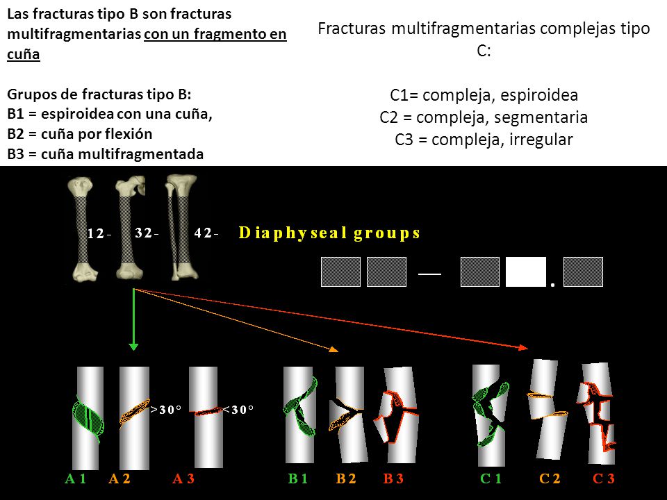 Fracturas multifragmentarias complejas tipo C: C1= compleja, espiroidea C2 = compleja, segmentaria C3 = compleja, irregular