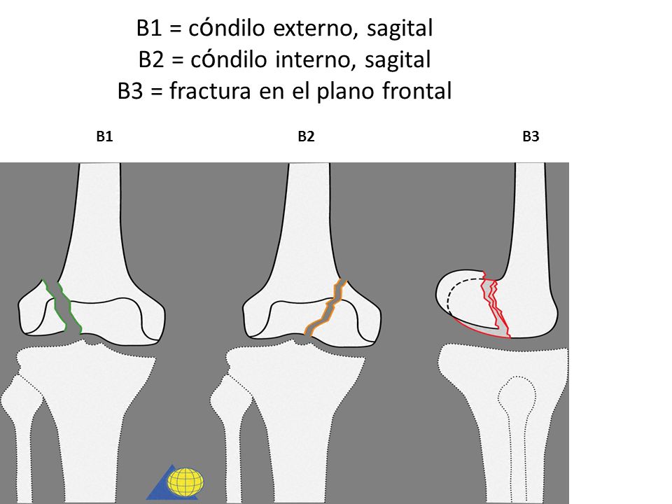 B1 = cóndilo externo, sagital B2 = cóndilo interno, sagital B3 = fractura en el plano frontal B1 B2 B3