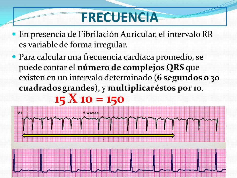 FRECUENCIA En presencia de Fibrilación Auricular, el intervalo RR es variable de forma irregular.