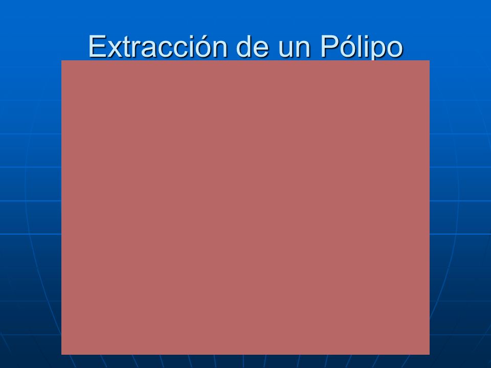 Extracción de un Pólipo