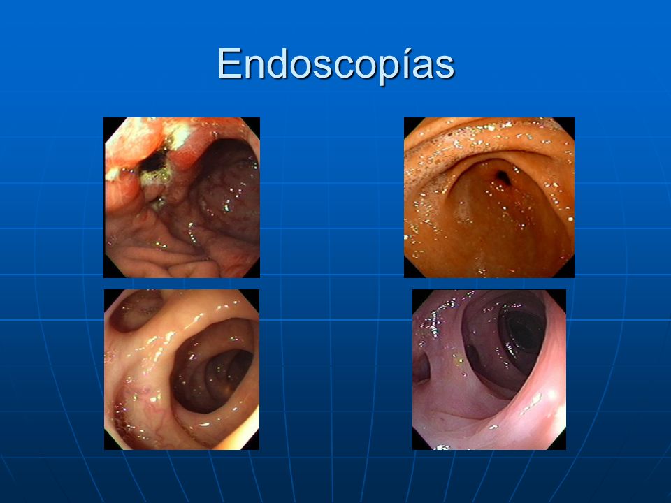 Endoscopías