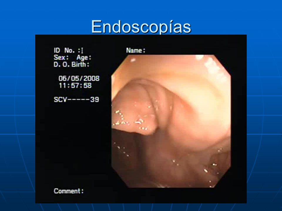 Endoscopías