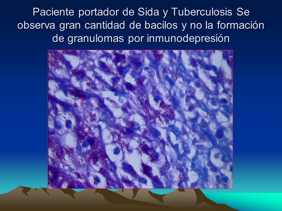 Paciente portador de Sida y Tuberculosis Se observa gran cantidad de bacilos y no la formación de granulomas por inmunodepresión