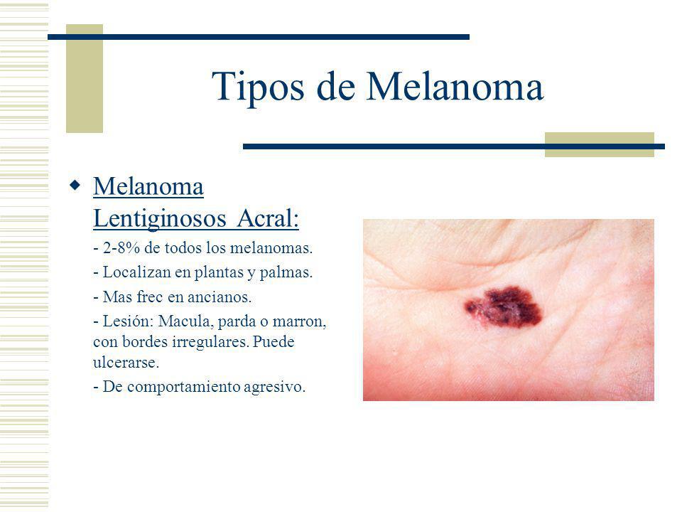 Tipos de Melanoma Melanoma Lentiginosos Acral: