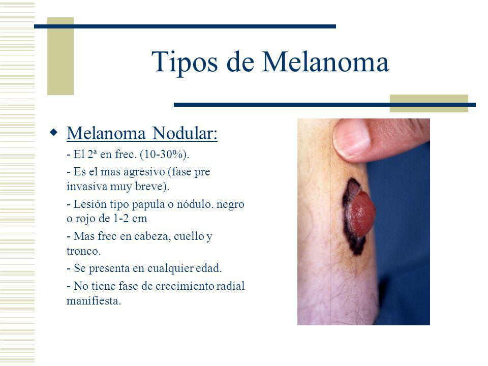 Tipos de Melanoma Melanoma Nodular: - El 2ª en frec. (10-30%).
