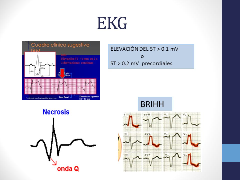 EKG BRIHH ELEVACIÓN DEL ST > 0.1 mV o ST > 0.2 mV precordiales