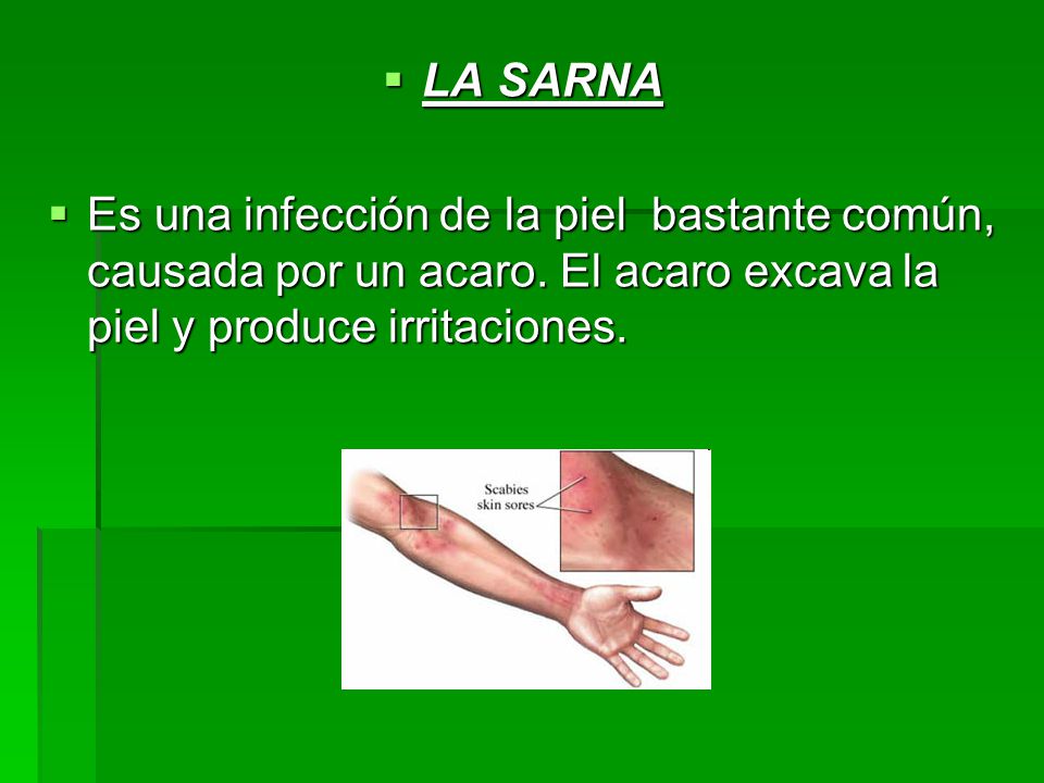 LA SARNA Es una infección de la piel bastante común, causada por un acaro.