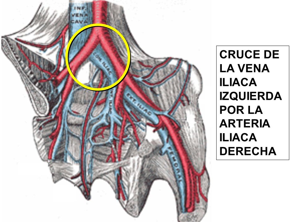 CRUCE DE LA VENA ILIACA IZQUIERDA POR LA ARTERIA ILIACA DERECHA