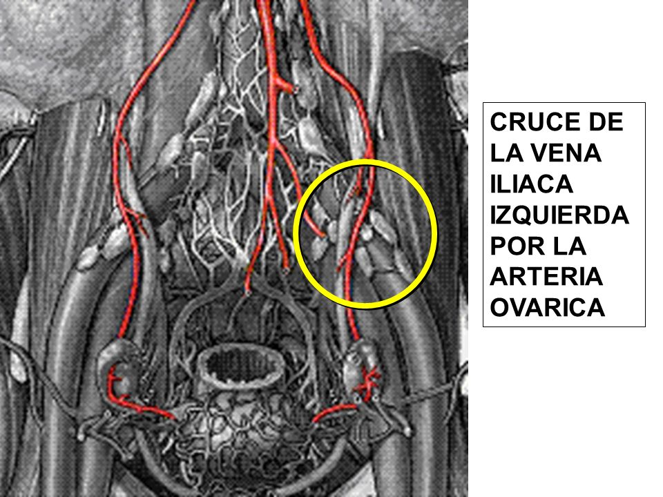CRUCE DE LA VENA ILIACA IZQUIERDA POR LA ARTERIA OVARICA