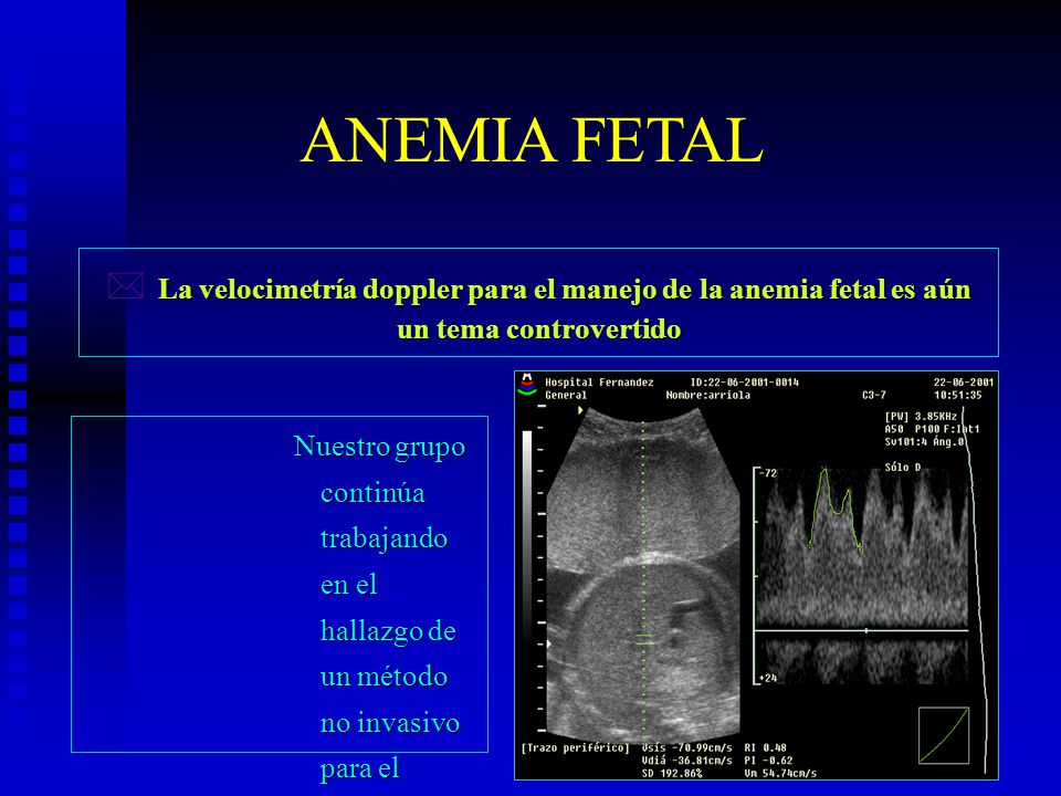 ANEMIA FETAL La velocimetría doppler para el manejo de la anemia fetal es aún un tema controvertido.
