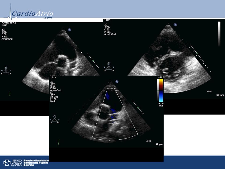 Tetralogia de Fallot reparada en la que podemos observar la valvula pulmonar engrosada y con movilidad reducida, con importante aumento de presiones a nivel de VD que generan movimiento septal anomalo.