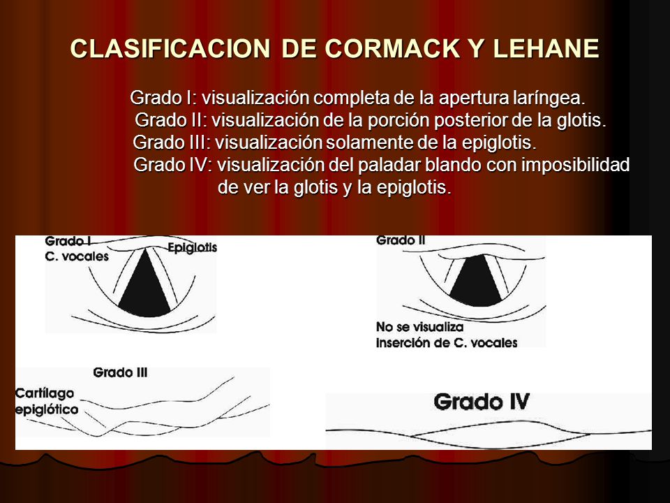 CLASIFICACION DE CORMACK Y LEHANE Grado I: visualización completa de la apertura laríngea.