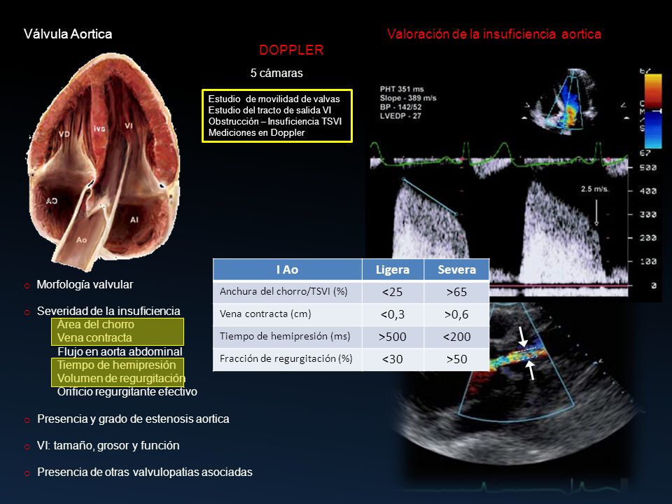 Válvula Aortica Valoración de la insuficiencia aortica DOPPLER