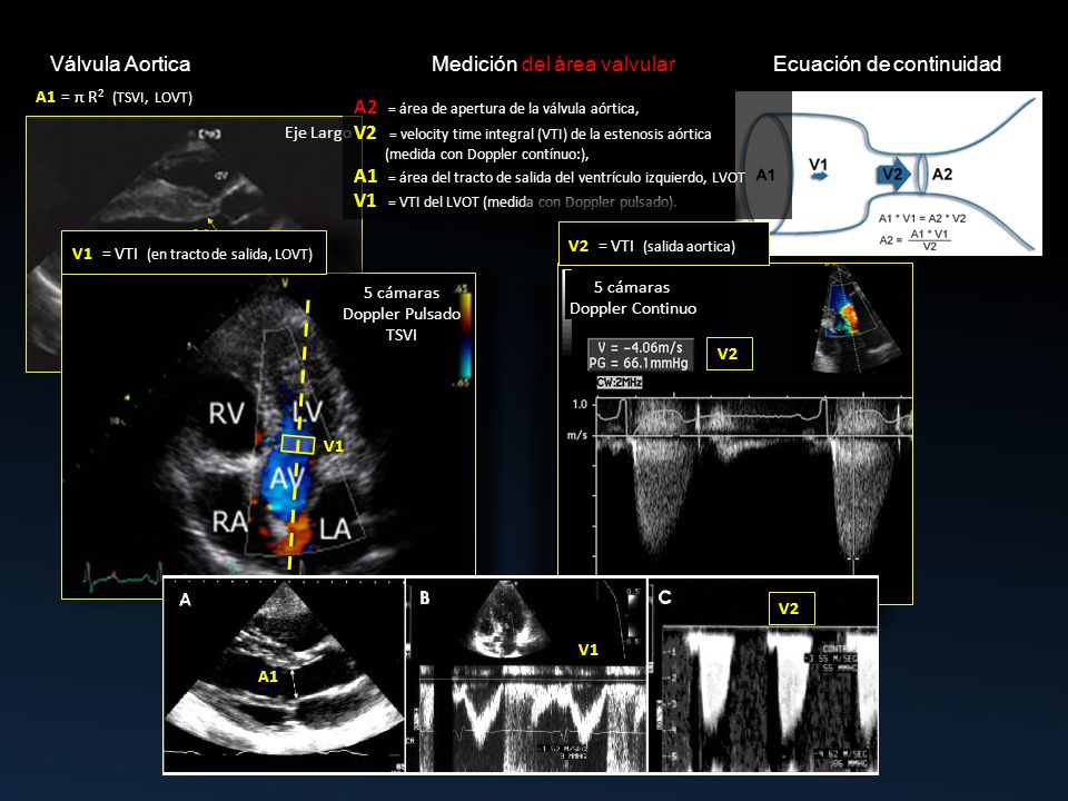 Válvula Aortica Medición del área valvular Ecuación de continuidad