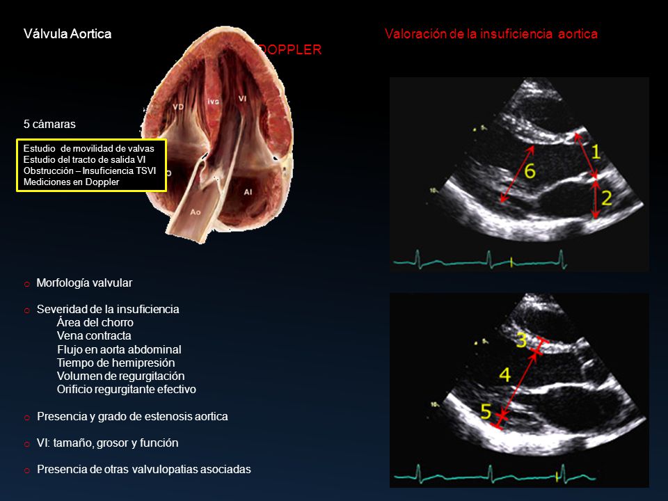 Válvula Aortica Valoración de la insuficiencia aortica DOPPLER