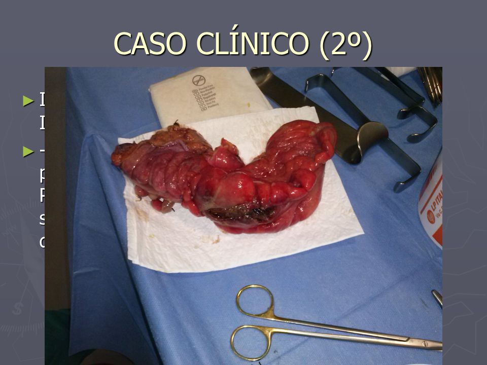 CASO CLÍNICO (2º) IQRESECCIÓN ANTERIOR ALTA CON ILEOSTOMÍA DE PROTECCIÓN.