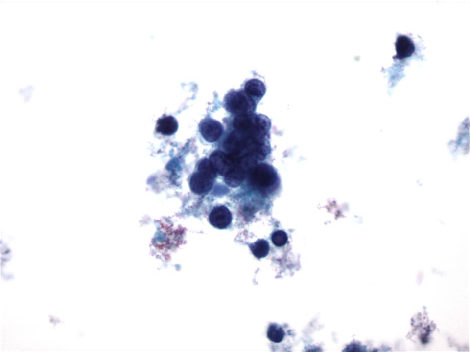 Carcinoma de célula pequeña en LCR a 40X