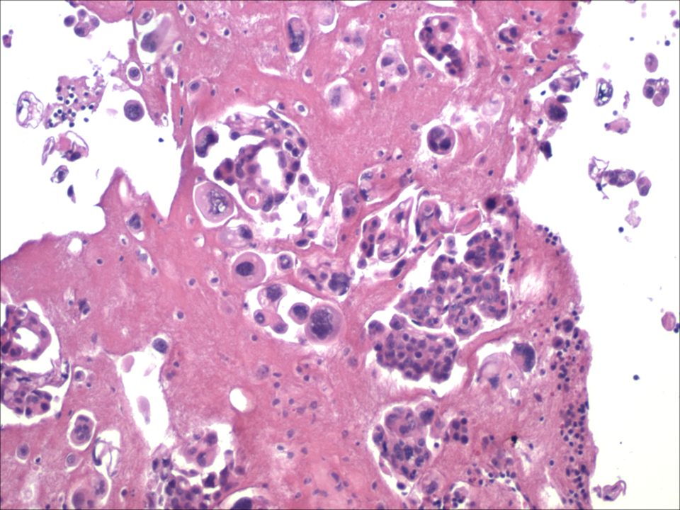 10X bloque celular del caso anterior (adenocarcinoma en un líquido pleural