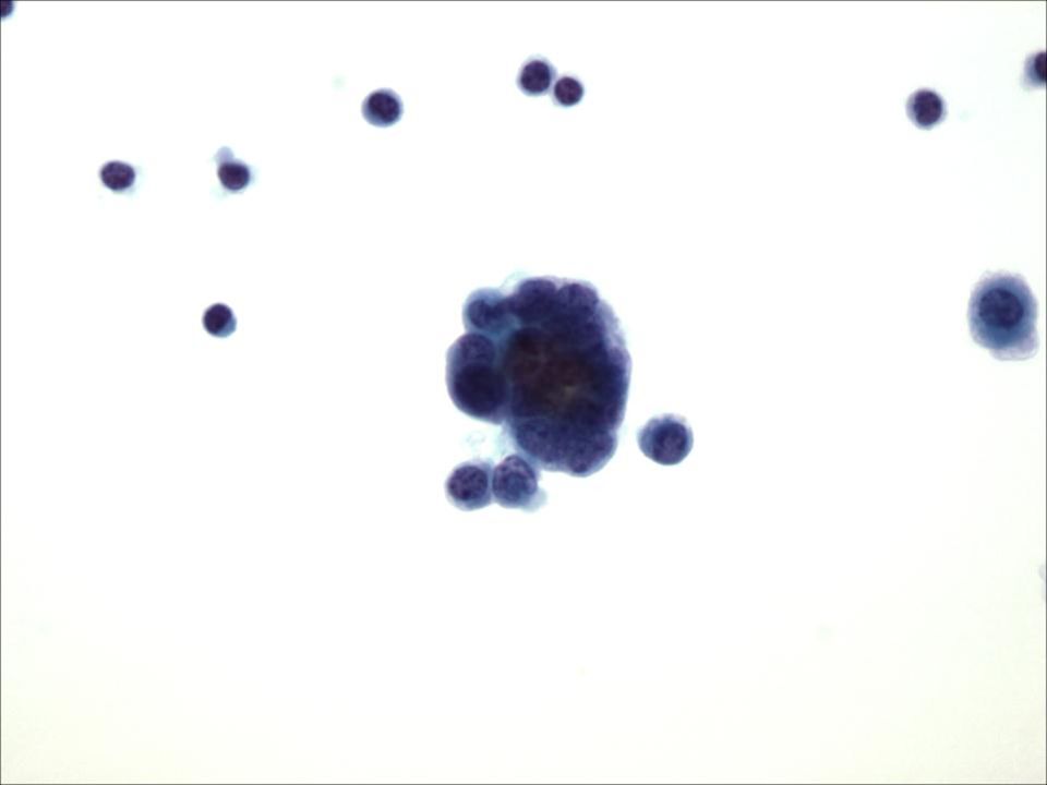 Carcinoma de Célula Pequeña de un líquido pleural a 40x