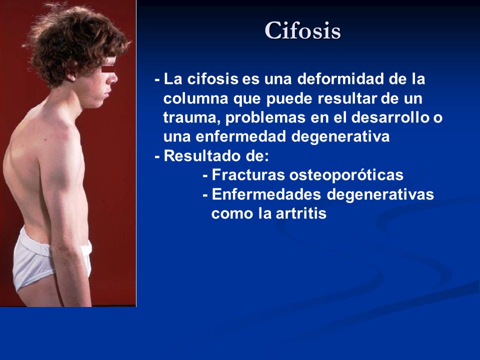 Cifosis - La cifosis es una deformidad de la