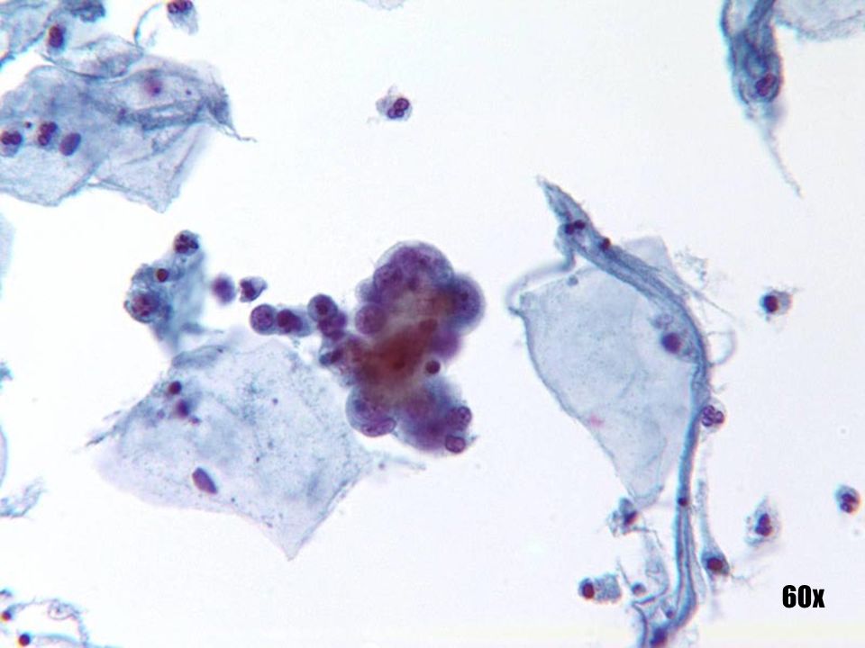 Adenocarcinoma endometrial •El grupo muestra las características clásicas de un adenocarcinoma, como las disposiciones tridimensionales tipo bola con contorno normal del grupo. Observe el pequeño tamaño de este grupo con respecto a una célula escamosa intermedia. En general, las células pequeñas en pequeños grupos apuntan a un origen endometrial. •La ingestión célula a célula y las características fagocíticas se asocian más comúnmente al adenocarcinoma endometrial. •Observe el fondo de la apoptosis de células aisladas, característico del origen endometrial. El grupo aislado aparece un poco fuera de contexto con el componente ectocervical benigno y maduro. La paciente era postmenopaúsica y no atrófica.